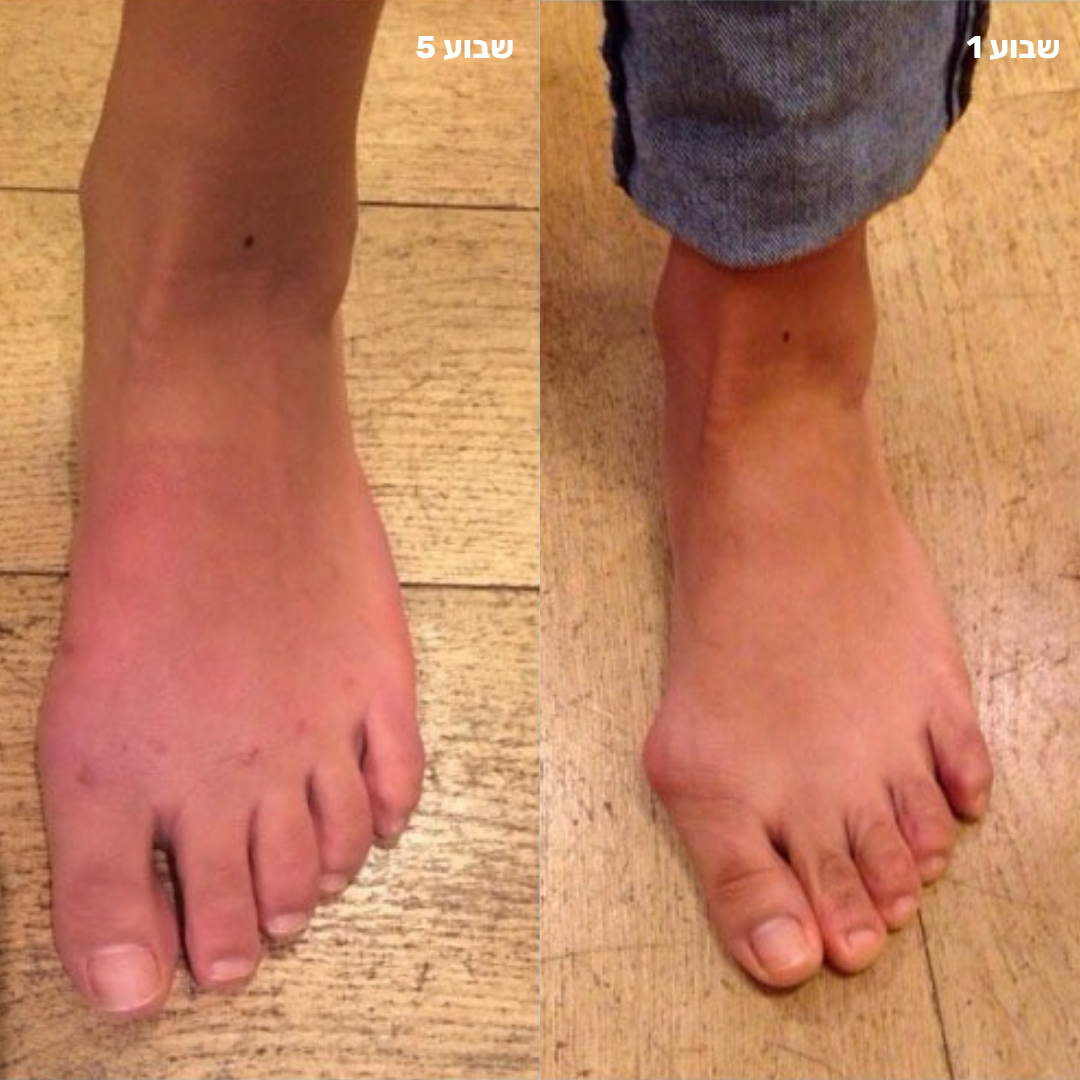 בוהניקס – משקם ומיישר הבוהן ומונע החמרה ללא ניתוח ב20 דקות מהבית!