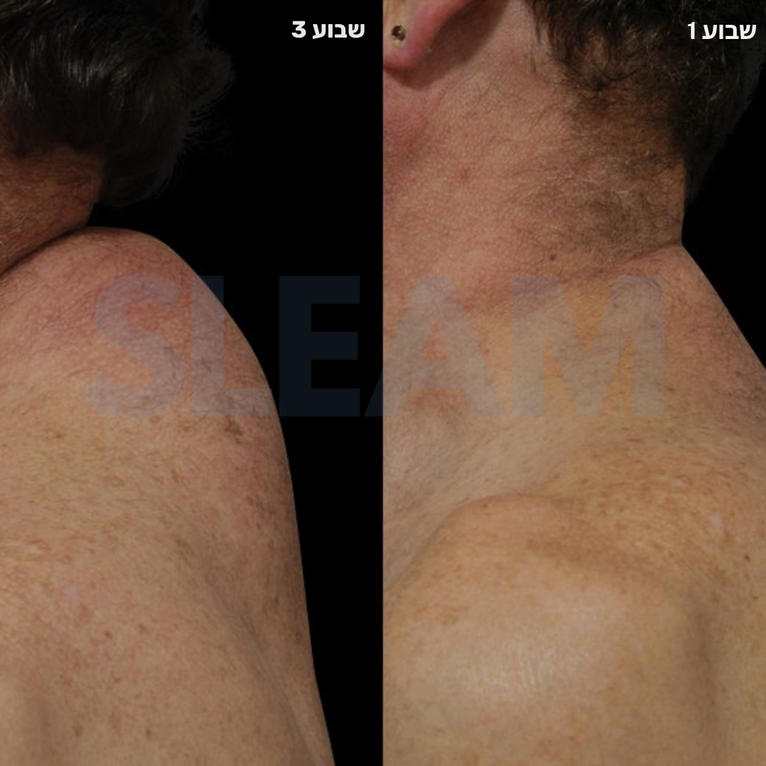 נק-מושן 360° מערכת שיקום צוואר ביתית שלמה Sleam